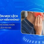 Chi Phí Nhổ Răng Khôn Mọc Lệch Ra Má Bao Nhiêu? Cập Nhật Mới Nhất