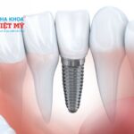 Overbite là gì? Những điều bạn cần biết