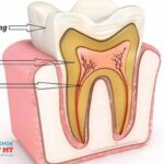 Lấy tủy xong bọc răng sứ liệu có đau?