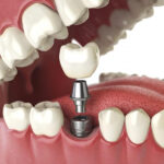 Những lưu ý cần biết khi chọn địa chỉ trồng răng Implant tại TPHCM