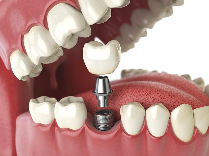 trong rang implant o TPHCM 7