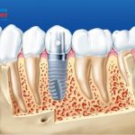 Trồng răng implant có vĩnh viễn? Khám phá lời giải đáp chi tiết