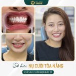 Hướng dẫn cách niềng răng bằng dây thun chi tiết nhất