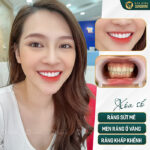 Chọn bàn chải tốt nhất: Niềng răng dùng bàn chải gì?